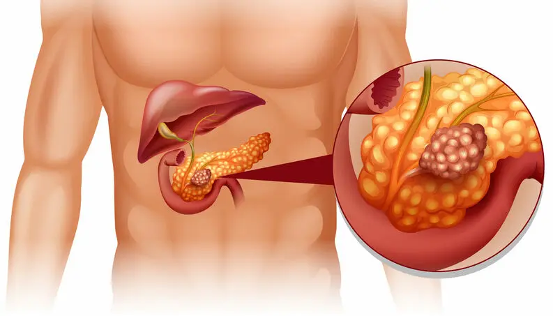 Ilustração médica sobre a saúde do pâncreas e monitoramento de sintomas abdominais